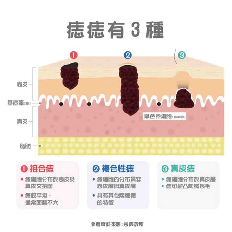 懷孕長痣|痣變大＝皮膚癌？醫曝「醜小鴨法則」看懂哪些痣最危。